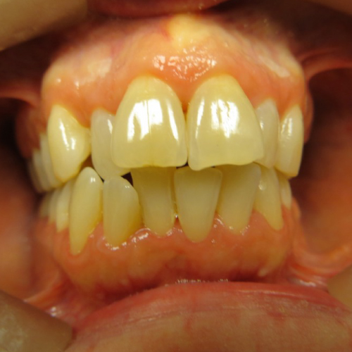 gold standard family dental odessa tx smile gallery before month braces image
