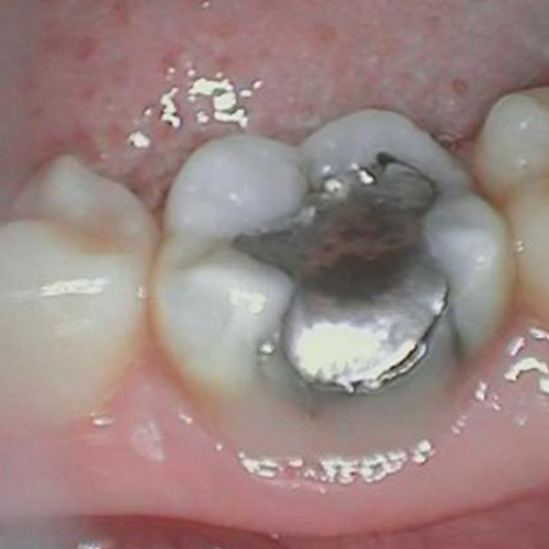 gold standard family dental odessa tx smile gallery failing silver filling image