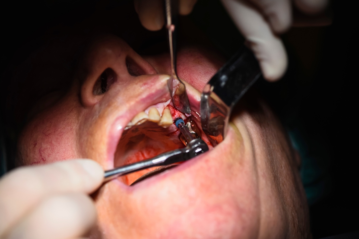 Oral Surgery Odessa