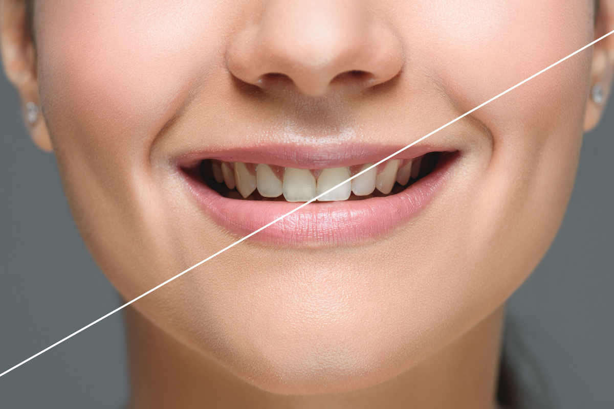 teeth whitening in Odessa