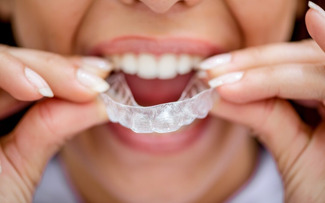 How Invisalign Can Easily Fit Into Your Busy Daily Routine